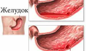 Осложнения язвенной болезни желудка и двенадцатиперстной кишки