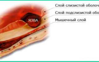 Лучшие лекарства от язвы 12 перстной кишки: препараты и схема