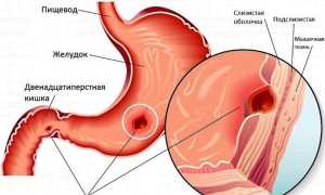 Язвенная болезнь у детей – причины, симптомы, диета, лечение