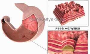 Эрозия желудка: что это такое, как диагностировать недуг и как лечить разными способами