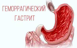 Эрозивный гастрит: симптомы и лечение желудка медикаментозными средствами