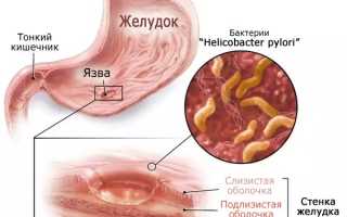 Можно ли курить при язве: двенадцатиперстной кишки, желудка