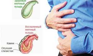 Острый холецистит: симптомы и лечение