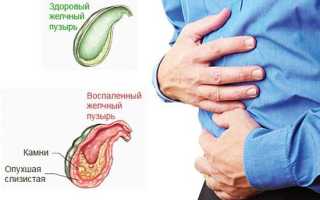 Острый холецистит: симптомы и лечение