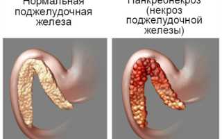 Кальцифицирующий панкреатит – причины и лечение