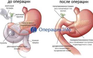 Операция на поджелудочной железе при панкреатите: показания, последствия