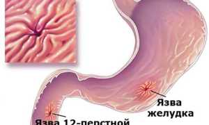 Язвенная болезнь двенадцатиперстной кишки: симптомы и лечение препаратами, диета