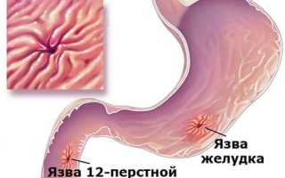 Язвенная болезнь двенадцатиперстной кишки: симптомы и лечение препаратами, диета