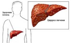 Признаки алкогольного цирроза печени, методы лечения, прогноз