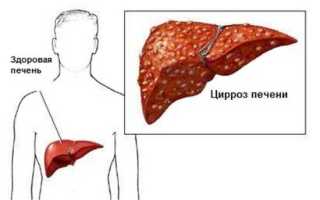 Признаки алкогольного цирроза печени, методы лечения, прогноз