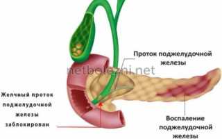 Панкреатит у взрослых мужчин: признаки и симптомы