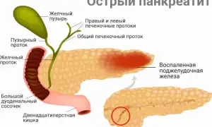 Панкреатит