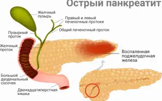 Панкреатит