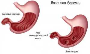 Лечение язвы желудка народными средствами самые эффективные – 17 рецептов