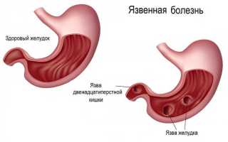 Лечение язвы желудка народными средствами самые эффективные – 17 рецептов