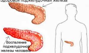 Тошнота при панкреатите (заболеваниях поджелудочной железы), почему тошнит после еды, что делать, как и чем снять (убрать) симптом?