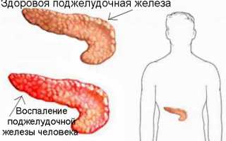 Тошнота при панкреатите (заболеваниях поджелудочной железы), почему тошнит после еды, что делать, как и чем снять (убрать) симптом?