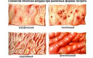 Что такое катаральный гастрит и как лечить: причины, симптомы
