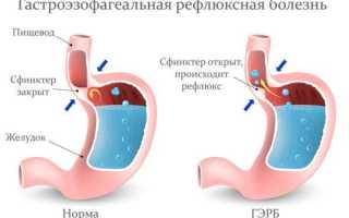 Во рту горечь и сухость причины и лечение, по утрам подробная информация