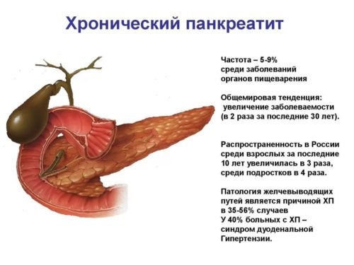 Обострение хронического панкреатита