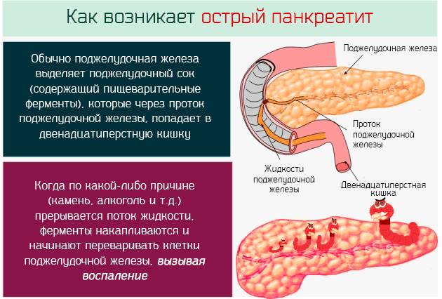 Острый панкреатит
