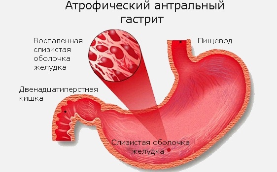 Атрофический гастрит