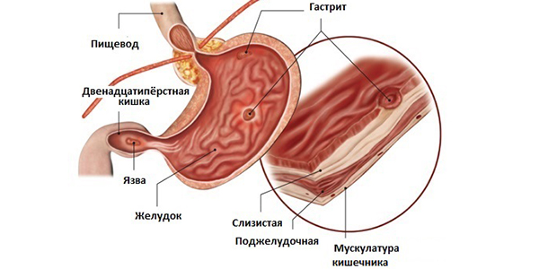 Что такое гастрит
