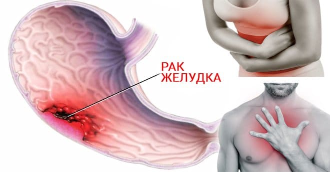 Осложнения курения на желудок