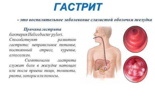 Что такое гастрит