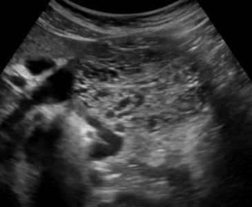 mikrotsistik-adenoma-pankreas