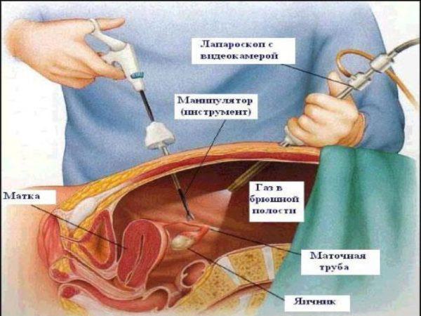 Проведение лапароскопии