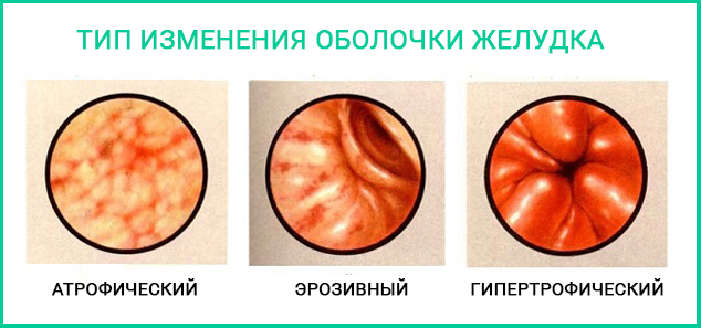 Гастрит желудка повышенная кислотность