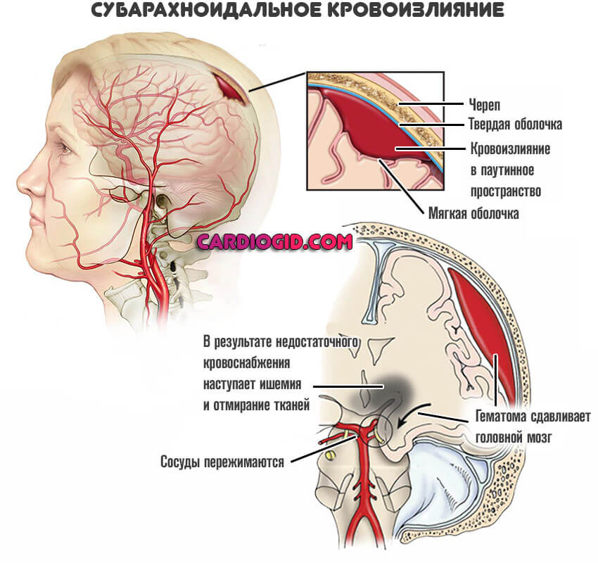 Субарахноидальное-кровоизлияние