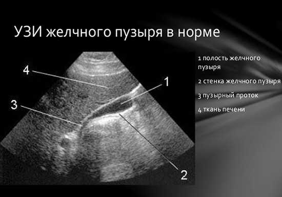 Узи желчного пузыря в норме