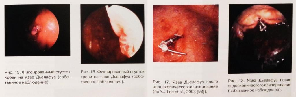 Ulcer treatment