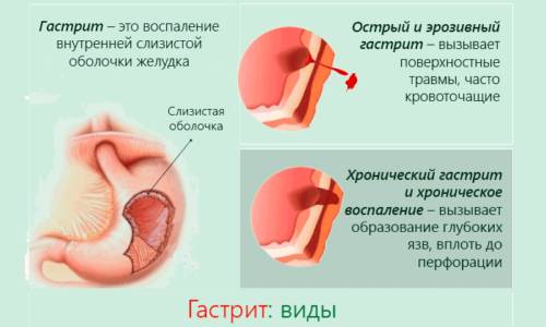 При гастрите и панкреатите возникает воспаление, при употреблении внутрь прополис оказывает антимикробное действие и помогает быстрее купировать воспалительные процессы в органах пищеварения