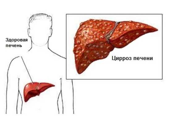 Алкогольный цирроз печени