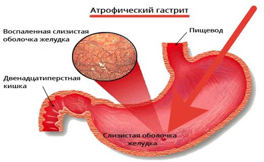 astrofiheskii_gastrit2