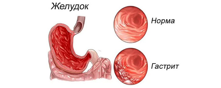 Гастрит