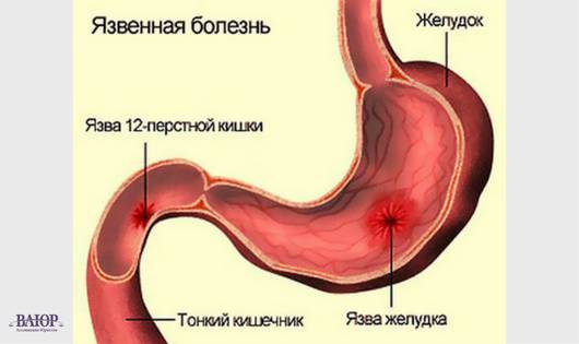 Причины и симптомы язвенной болезни