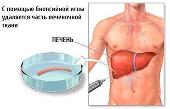 Что такое биопсия печени