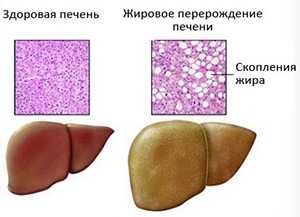 Что такое жировой гепатоз печени