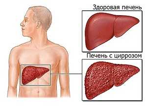 Цирроз печени