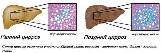 Цирроз печени стадии