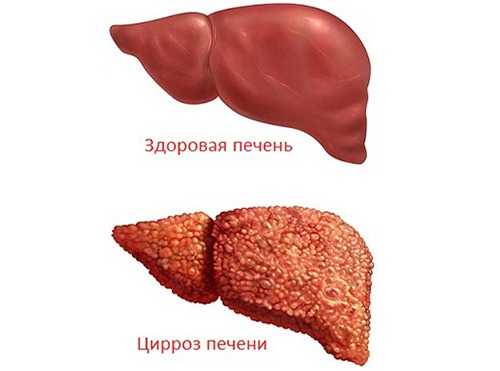 Цирроз печени