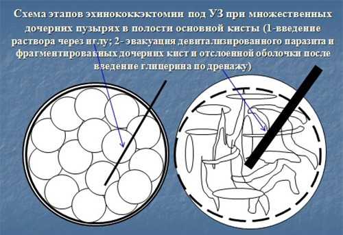 Эхинококкэктомия