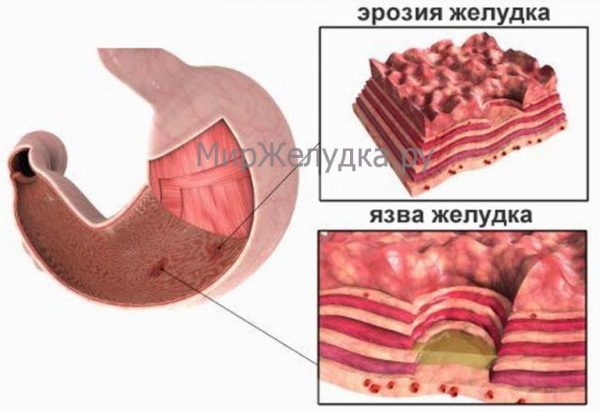 Эрозия слизистой желудка