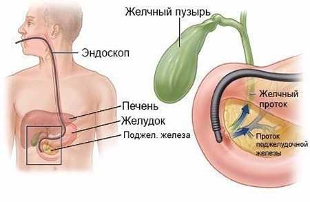Эндоскопическая ретроградная холангиопанкреатография