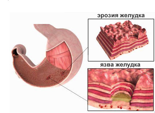 Эрозия желудка