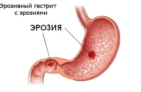 Эрозивный гастрит